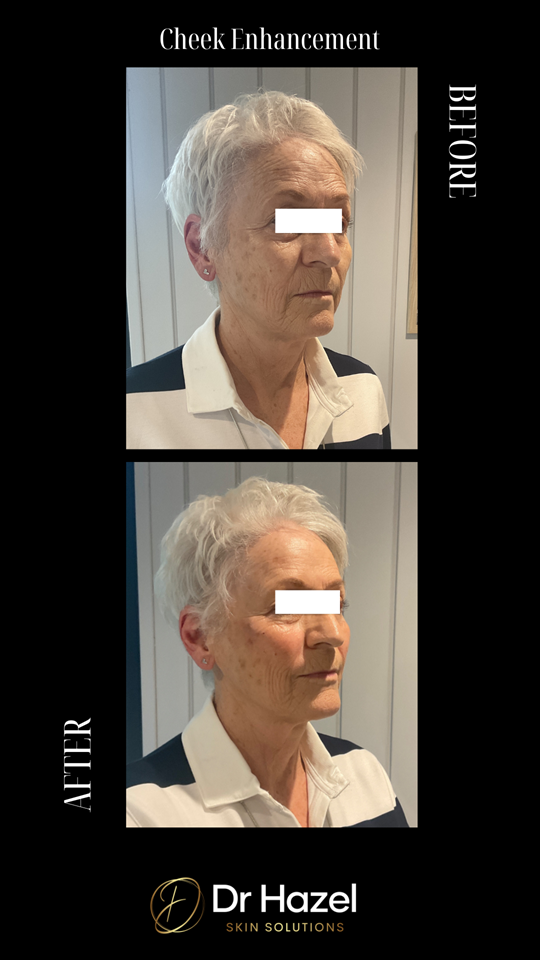 Before & After Cheek Filler