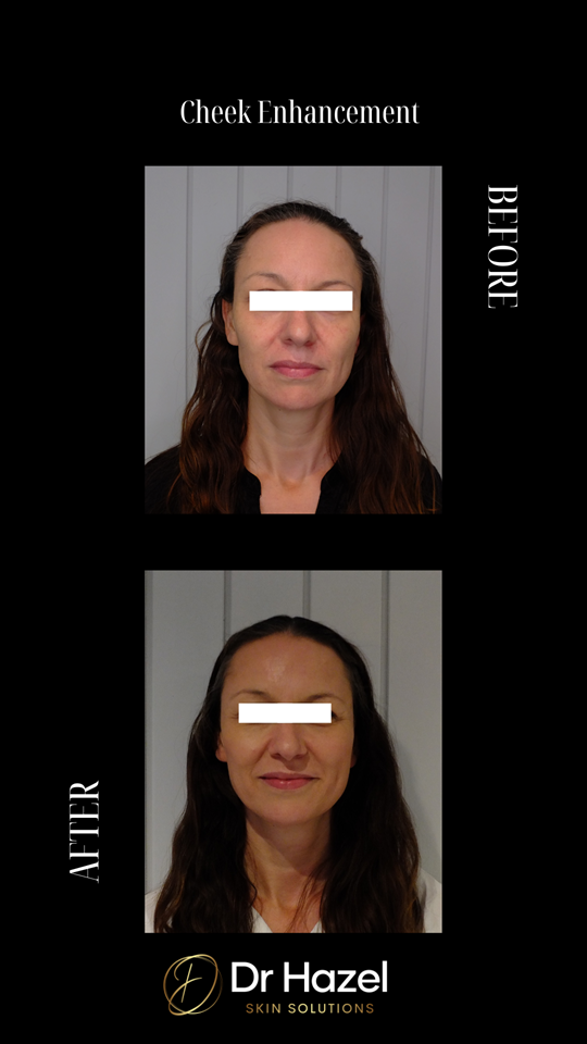Before & After Cheek Filler