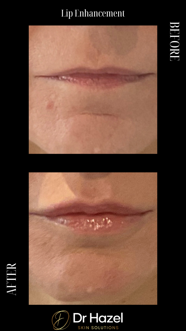 Before & After Lip Filler