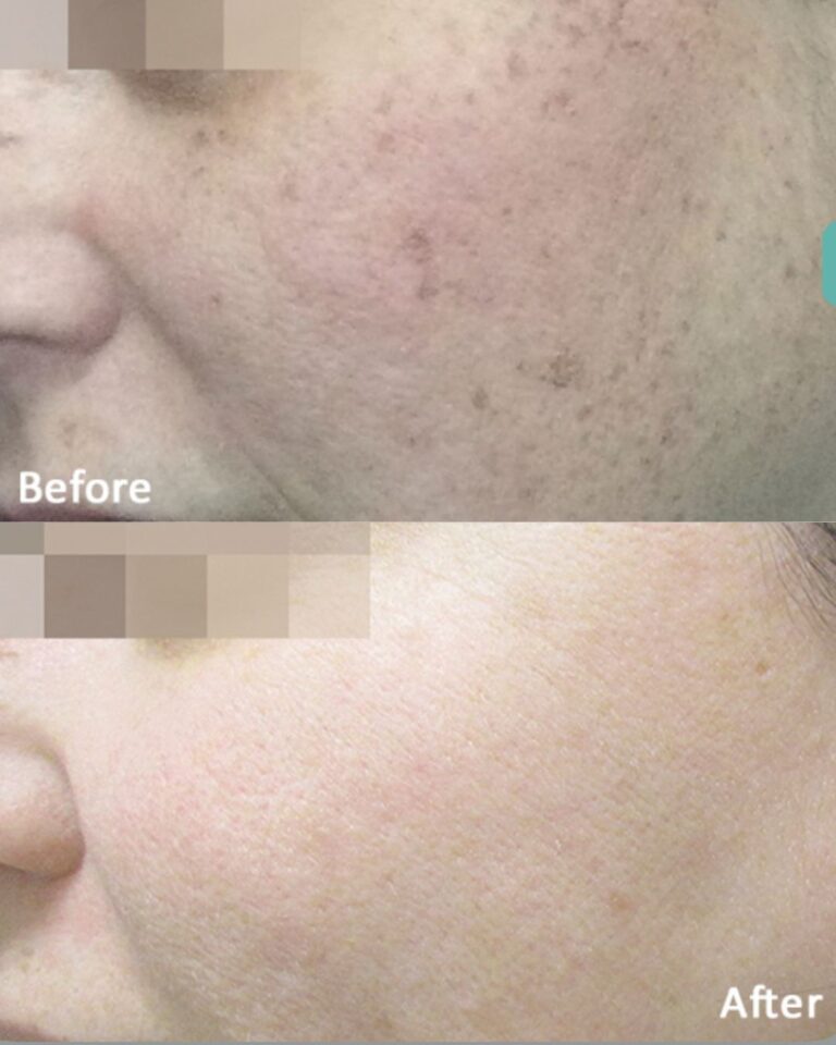 Before & After Lumecca IPL