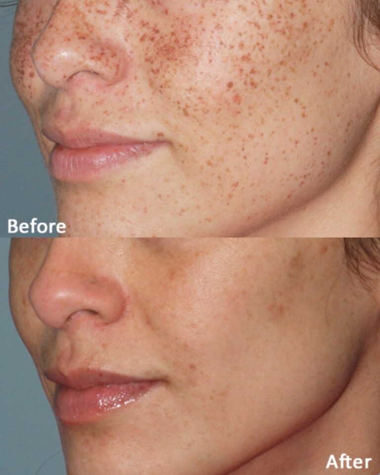 Before & After Lumecca IPL