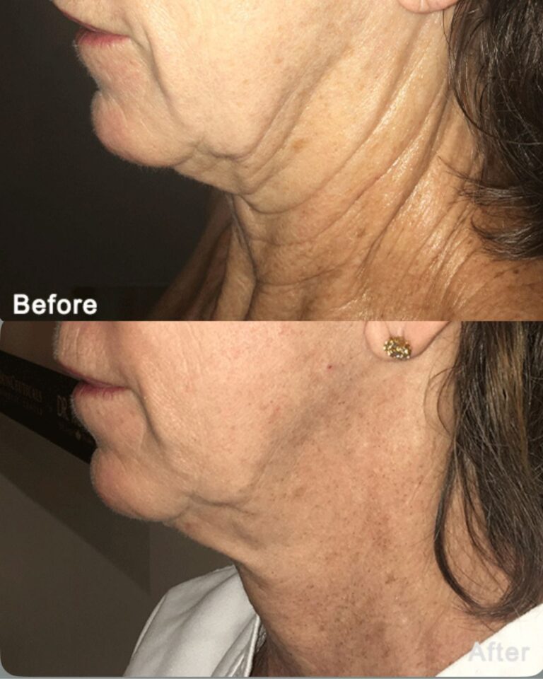Before & After Morpheus8
