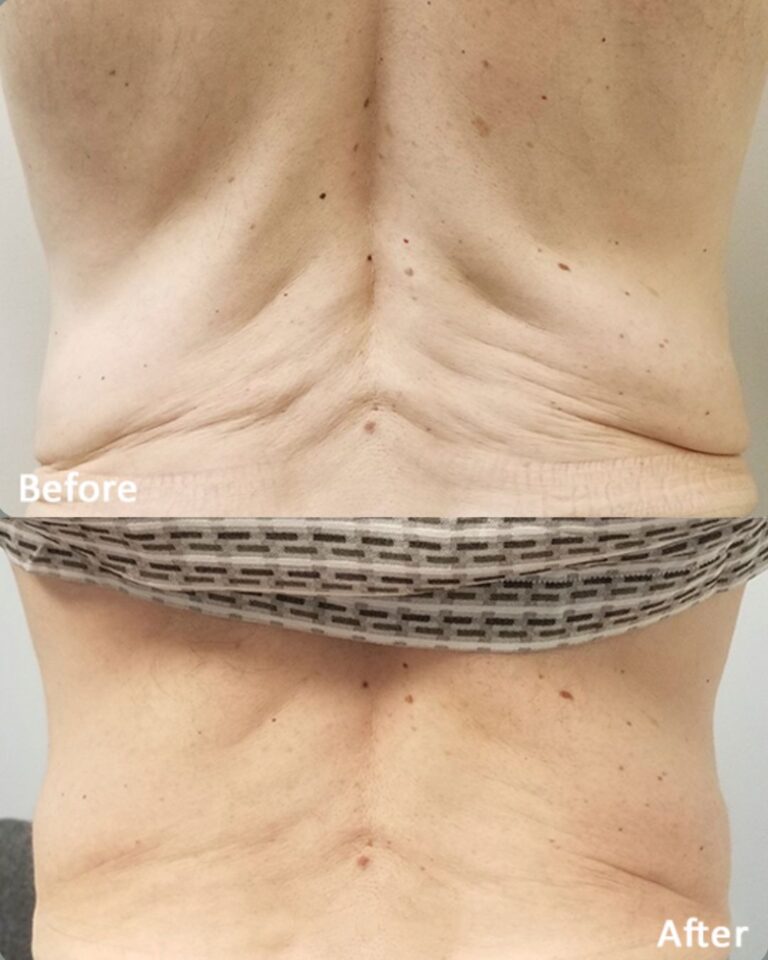 Before & After Morpheus8