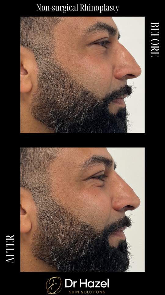 Before & After Non-surgical Rhinoplasty