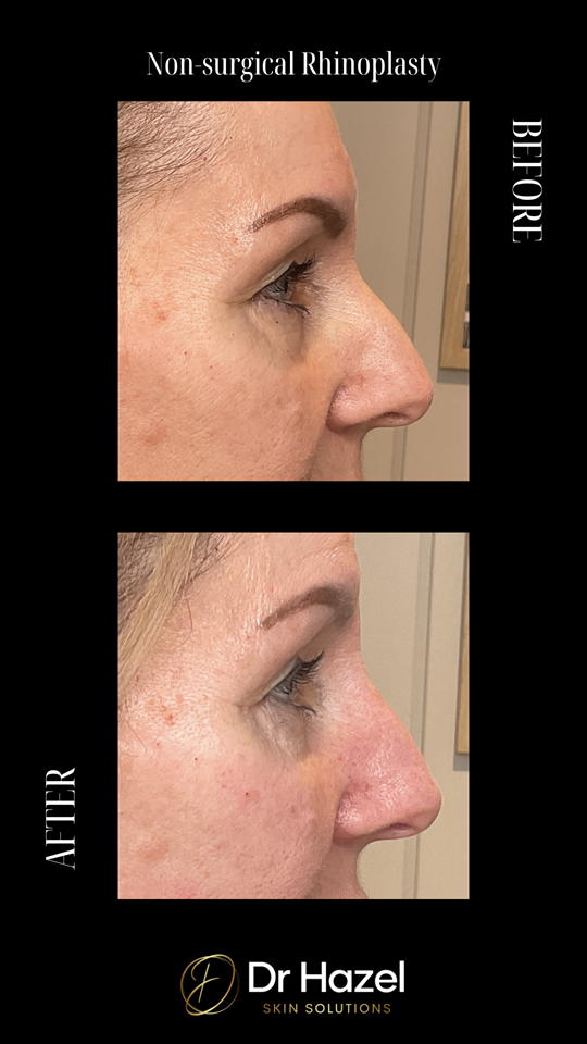 Before & After Non-surgical Rhinoplasty