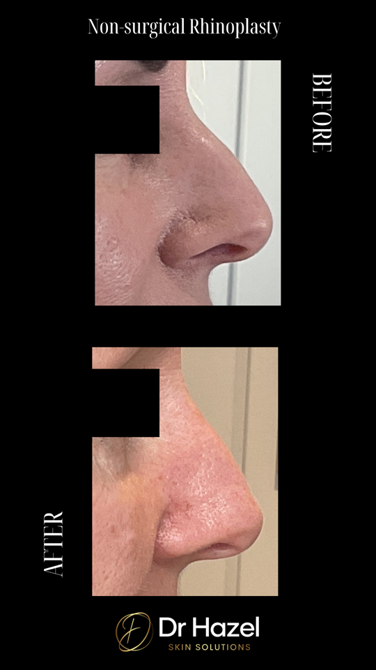 Before & After Non-surgical Rhinoplasty