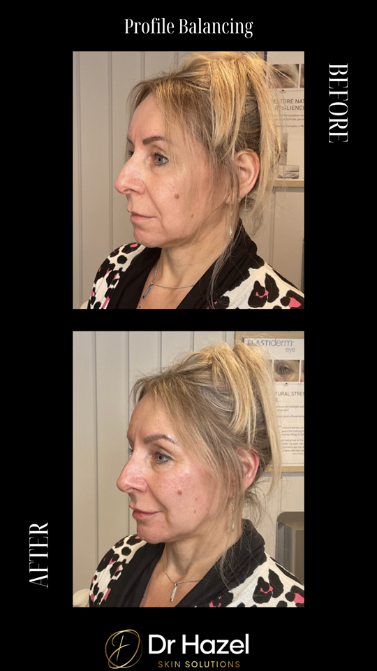 Before & After Profile Balancing