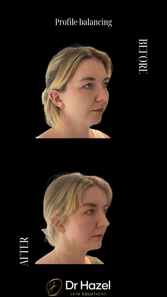 Before & After Profile Blalancing