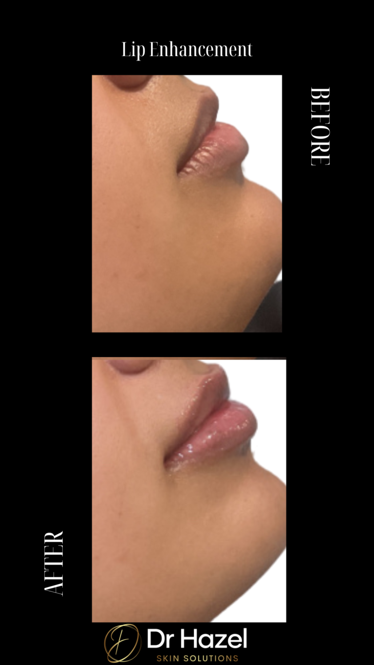 Before and After Lip Filler