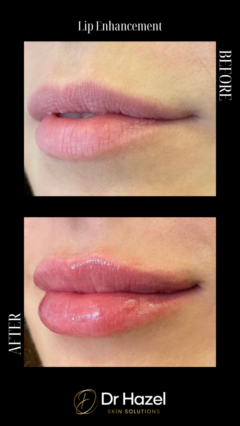 Before and After Lip Filler