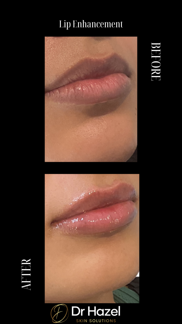 Before and After Lip Filler