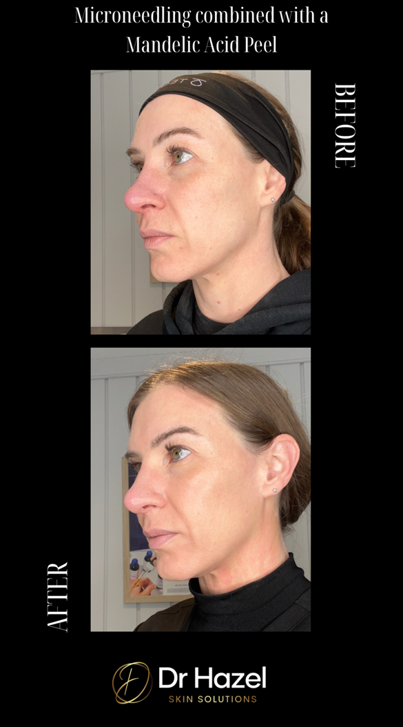 Before and After Microneedling