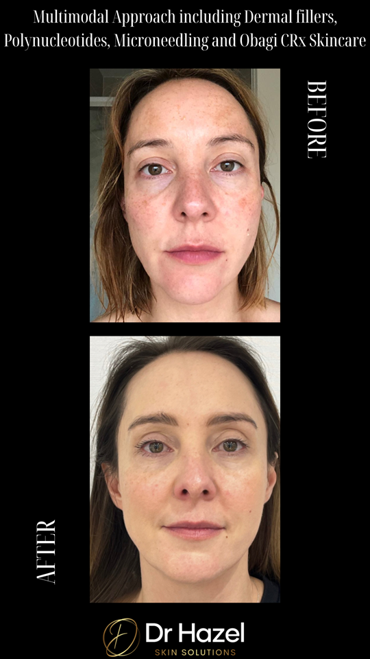 Before and After Microneedling
