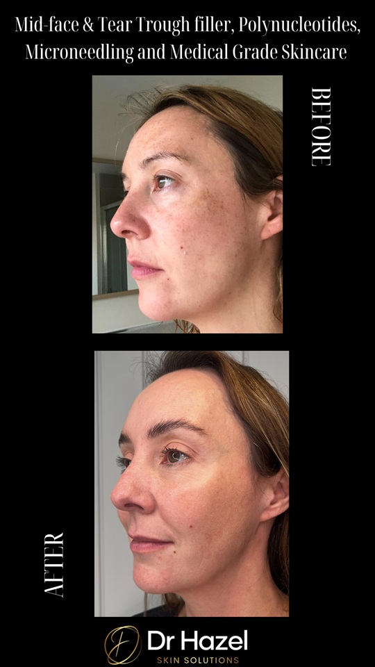 microneedling for stretch marks in warwickshire