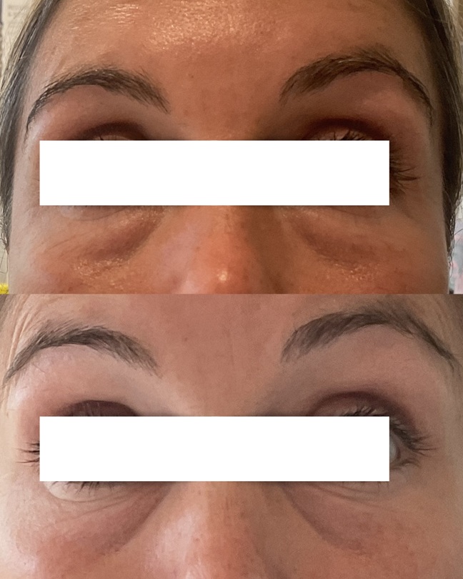 Polynucleotides represent one of the most advanced developments in regenerative skin medicine. Rather than simply hydrating the skin or adding volume, they work at a cellular and molecular level to repair, strengthen and regenerate skin tissue from within.