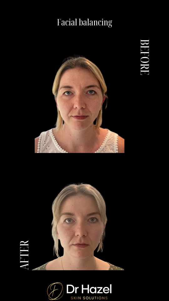 Before and After Profile Balancing
