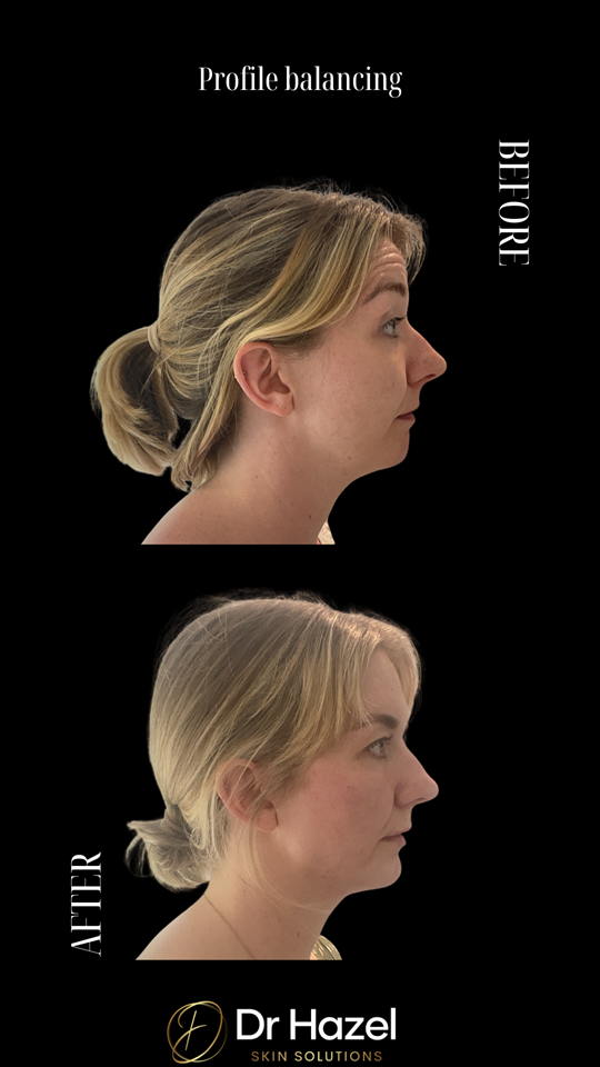 Before and After Profile Balancing