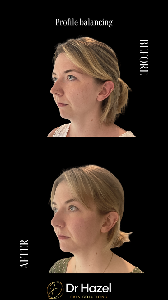 Before and After Profile Balancing