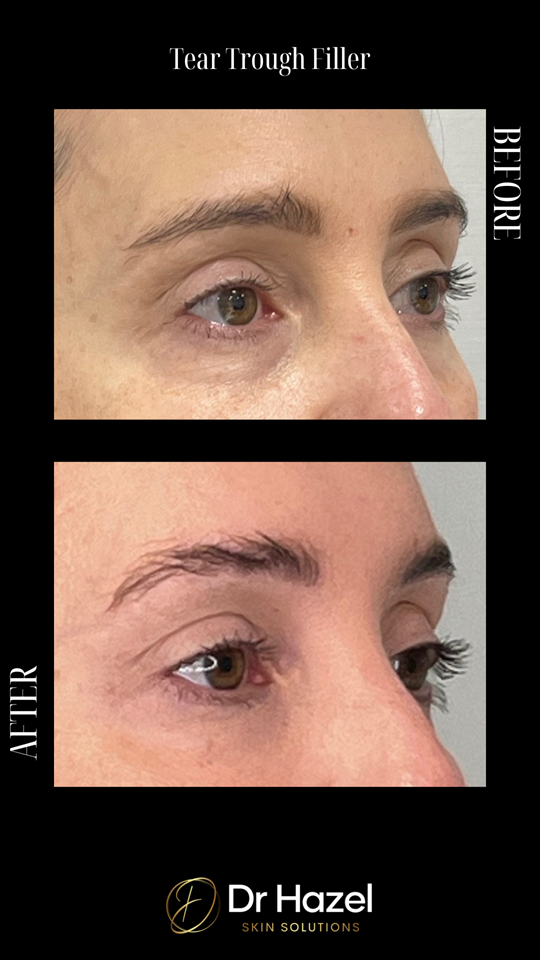 Before and After Tear Trough Filler