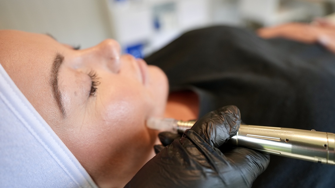 microneedling in warwickshire