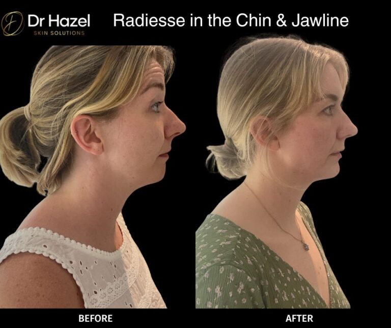 Radiesse in the chin & jawline