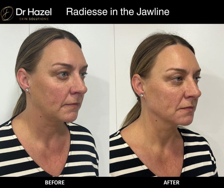 Radiesse in the jawline