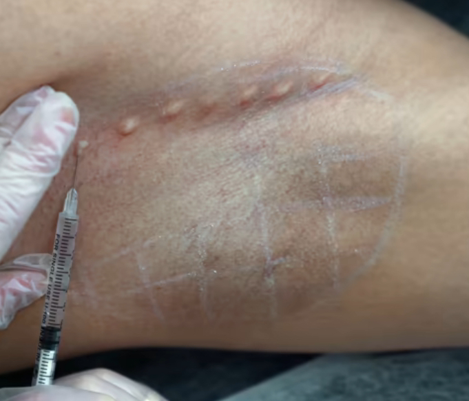 excessive sweating on underarm warwickshire