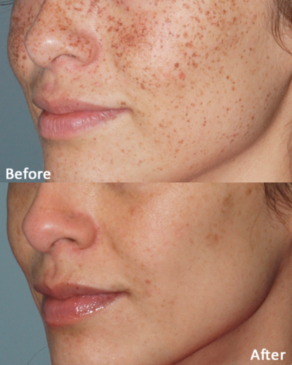 How many sessions of IPL do you need for pigmentation? 2 Before & After Lumecca IPL