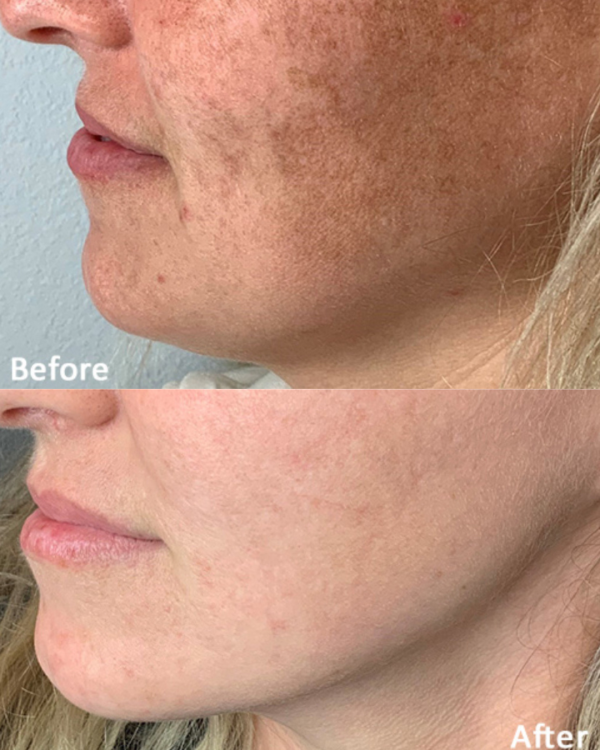 How many sessions of IPL do you need for pigmentation? 1 Before & After Lumecca IPL