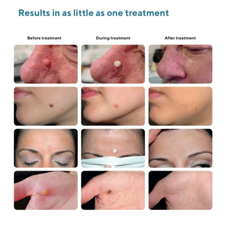 cryopen before and after