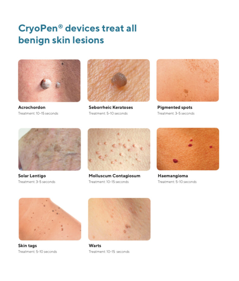 cryopen before and after