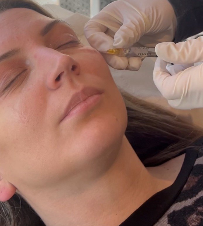 Polynucleotides represent one of the most advanced developments in regenerative skin medicine. Rather than simply hydrating the skin or adding volume, they work at a cellular and molecular level to repair, strengthen and regenerate skin tissue from within.