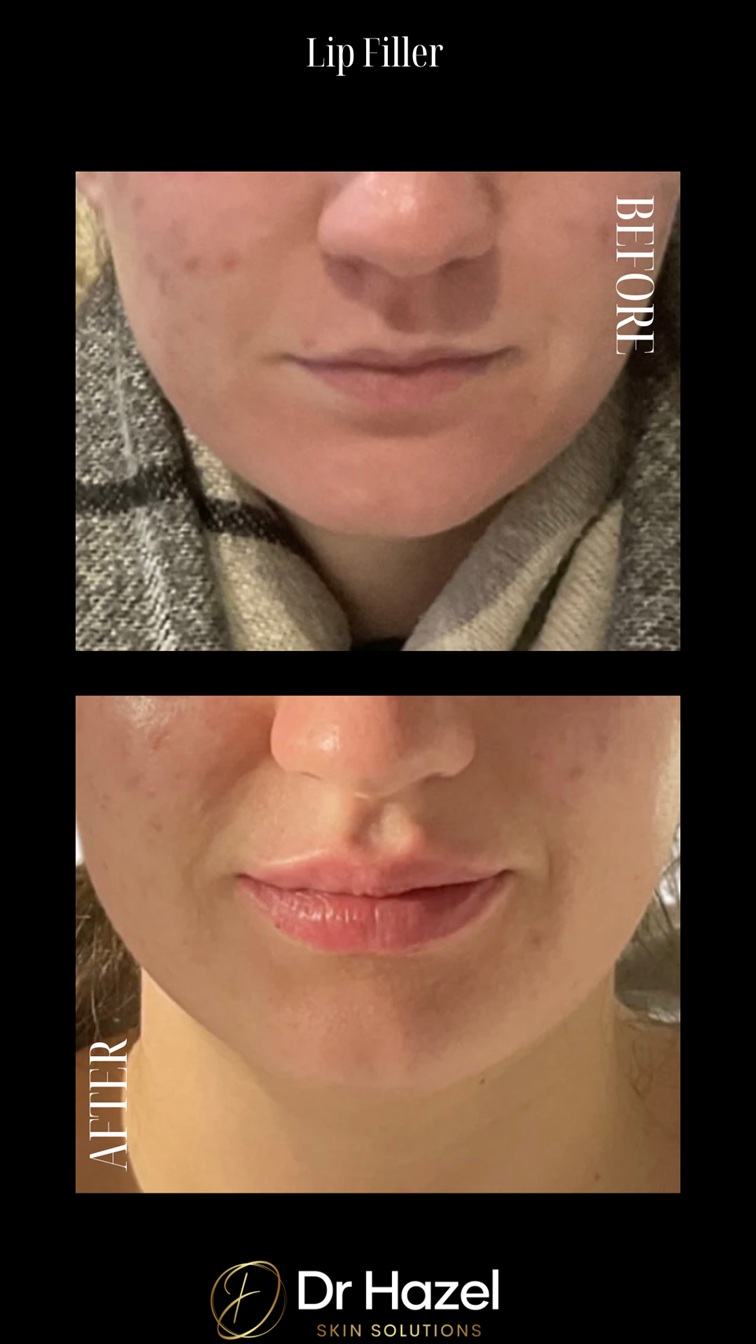 Lip filler before after