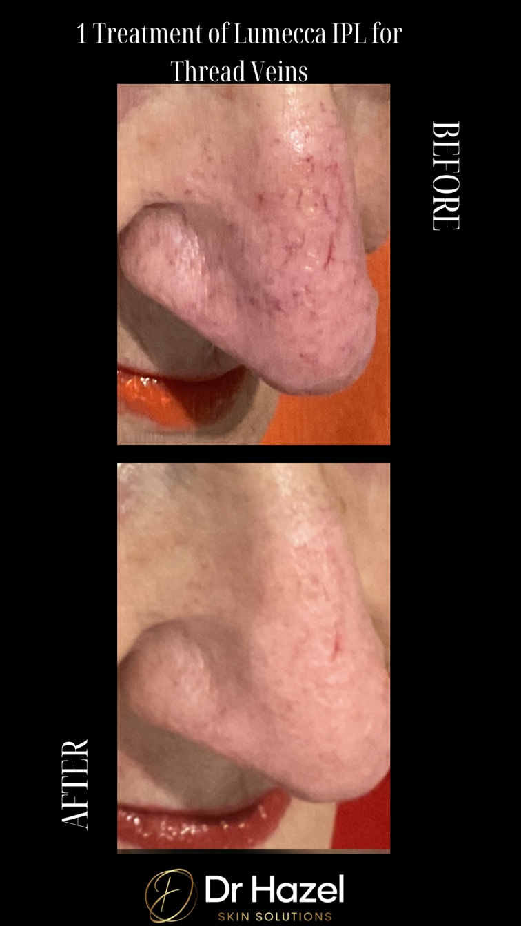 IPL Thread veins before after