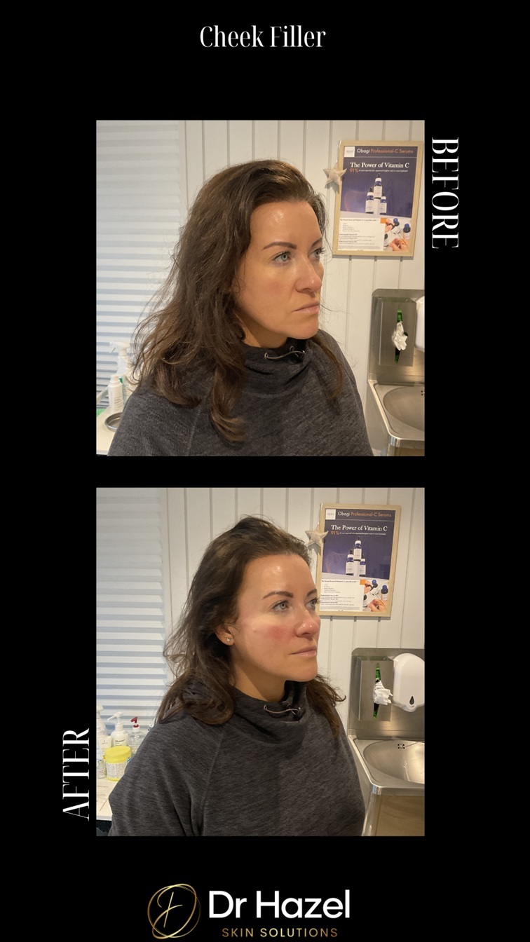 cheek filler before after