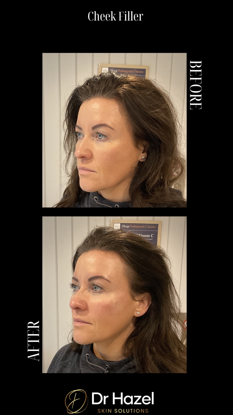 cheek filler before after