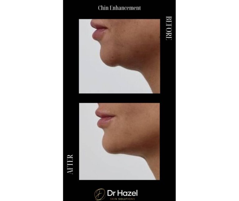 chin and jawline before after