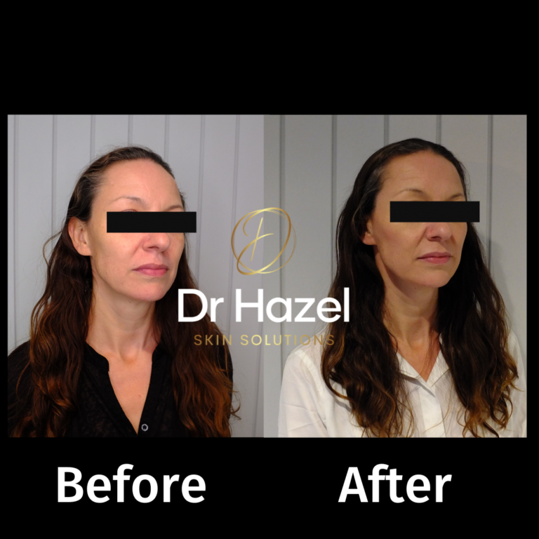 dermal filler before after