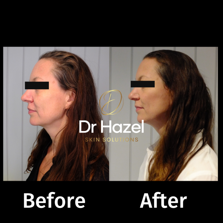 dermal filler before after