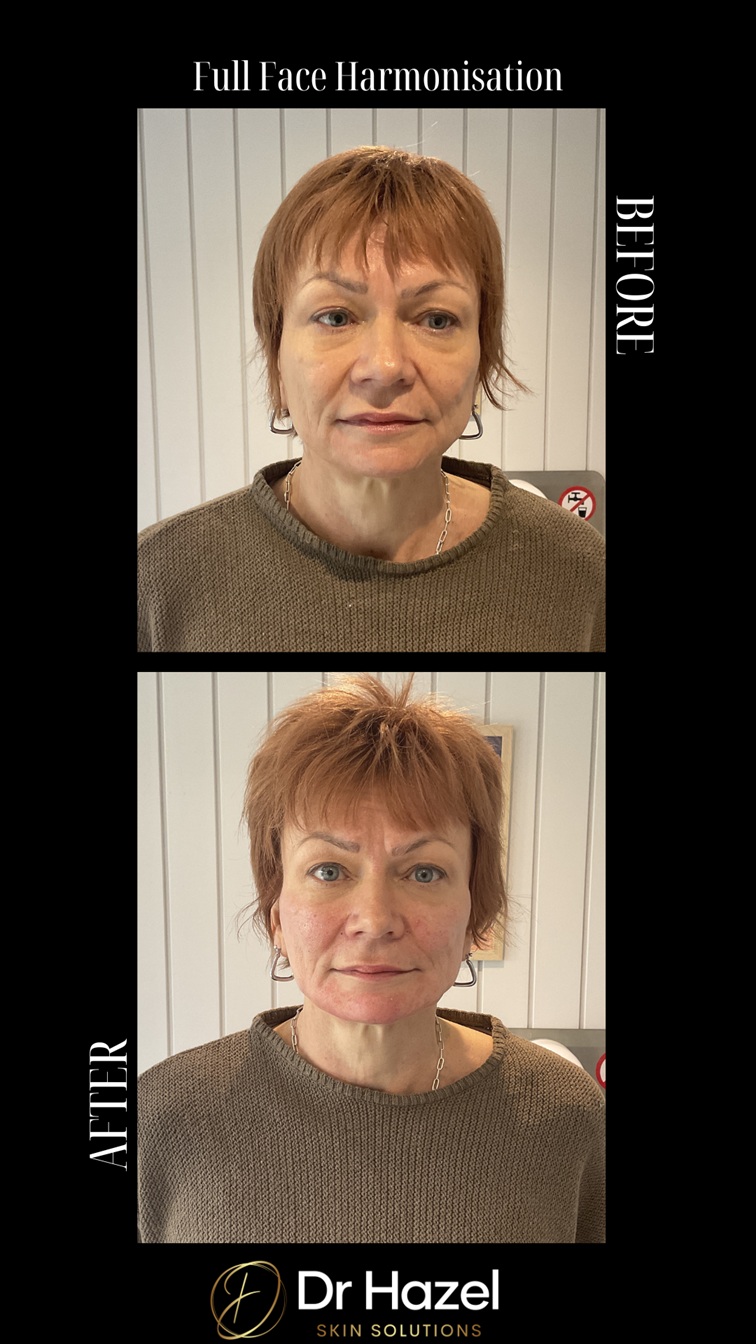full face harmonisation before after