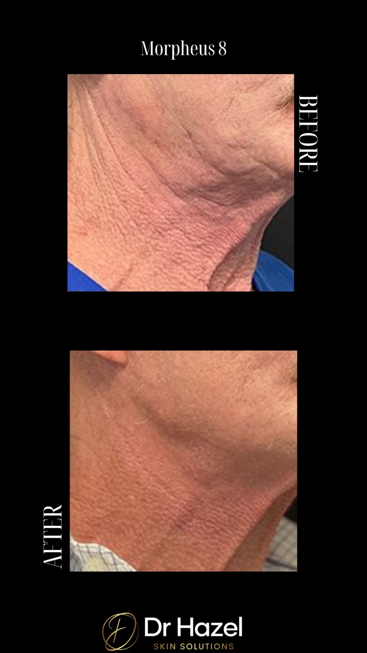 Before & After Morpheus8