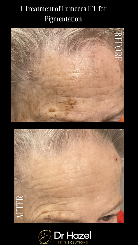 Before and after Lumecca IPL