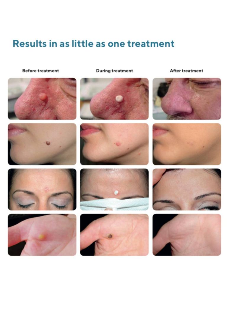 Clinical Dermatology 5 Before and After Cryopen treatment