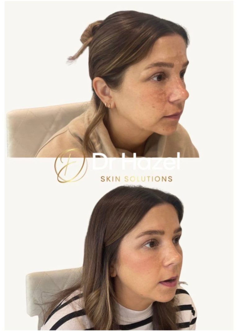 Clinical Dermatology 6 Before and After Melasma Pigmentation Treatment