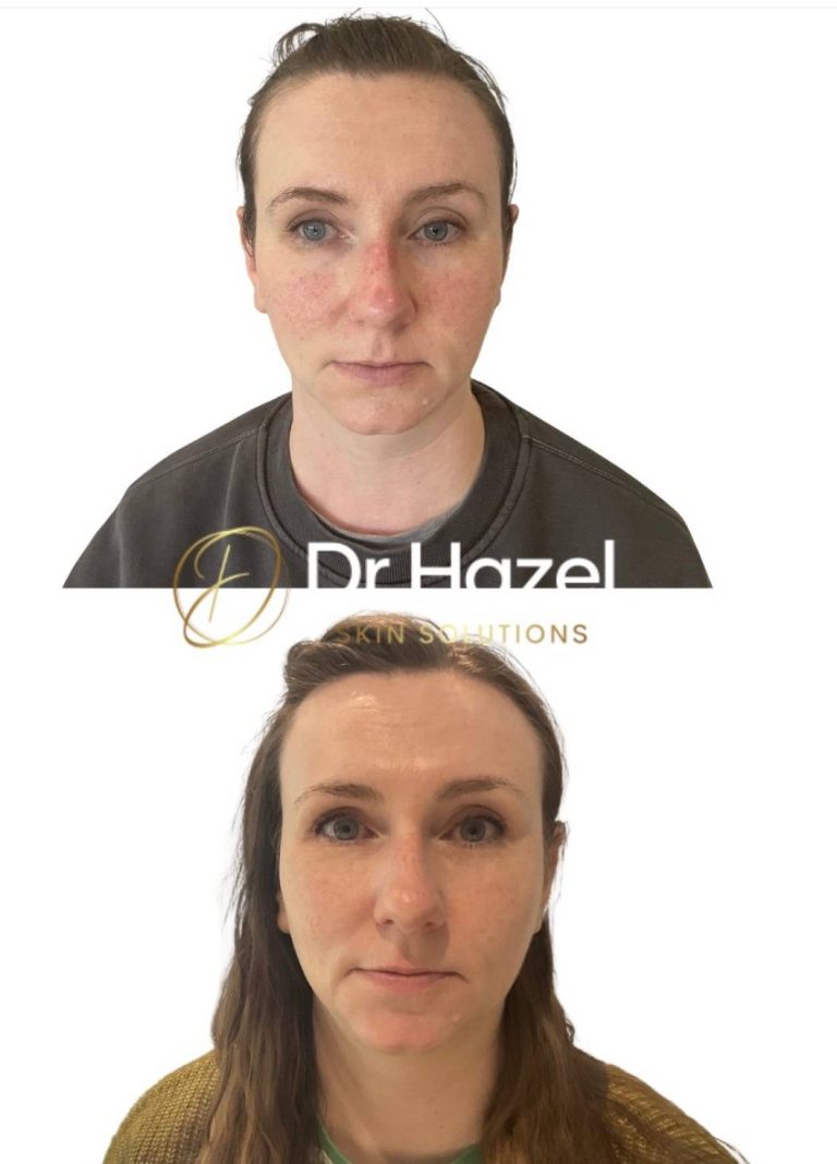 Clinical Dermatology 8 Before and After Rosacea Treatment