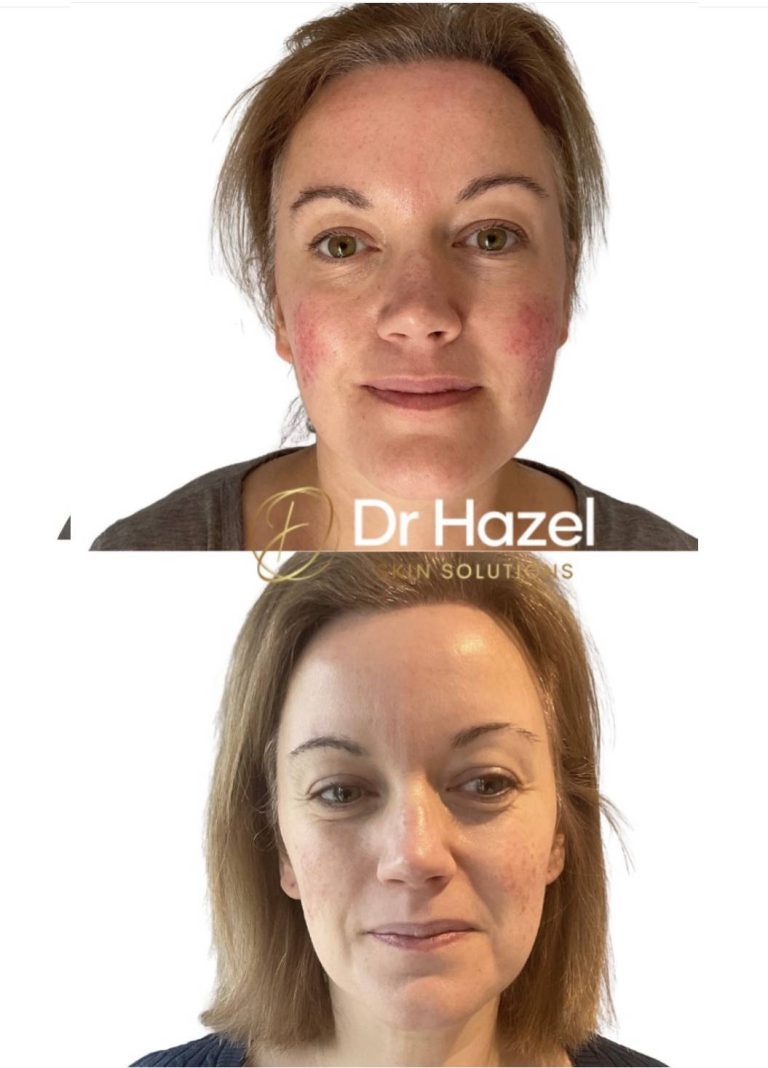 Clinical Dermatology 7 Before and After Rosacea Treatment