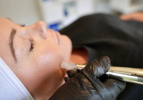 microneedling in warwickshire
